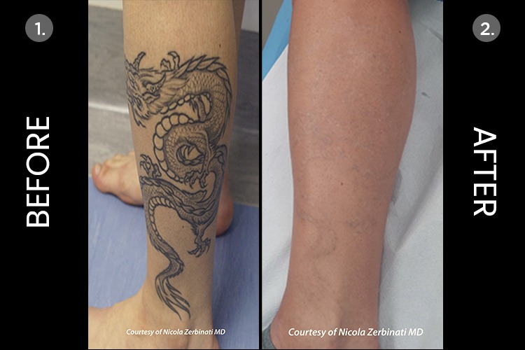 Laser Tattoo Removal Results - Tattoo Removal Sydney by NEXT LEVEL